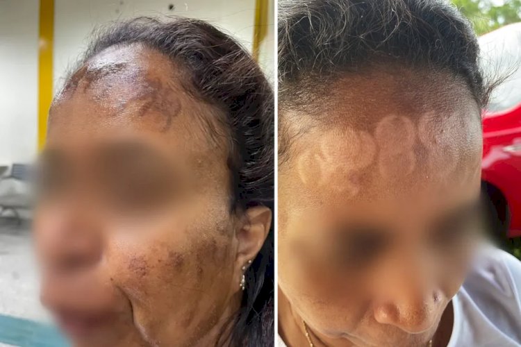 Após lesões por laser em clínica, professora desabafa: ‘Rosto queimado e sem poder sair’