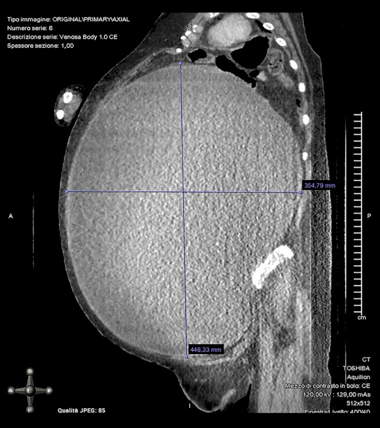 Mulher acredita estar com obesidade e retira cisto ovariano de 5Kg