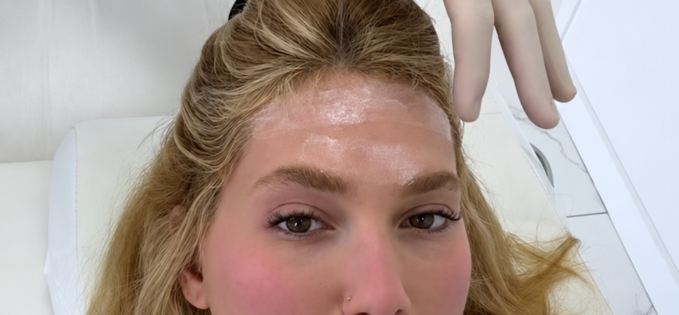 Por que aplicação de botox na cabeça pode ser usada contra enxaqueca?